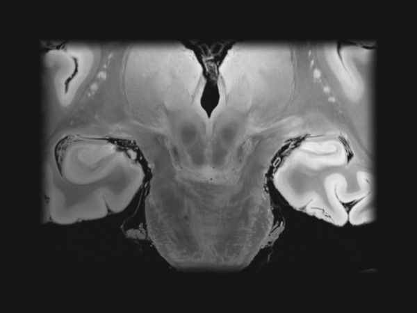 Coronal 7T MRI slice showing the hippocampus